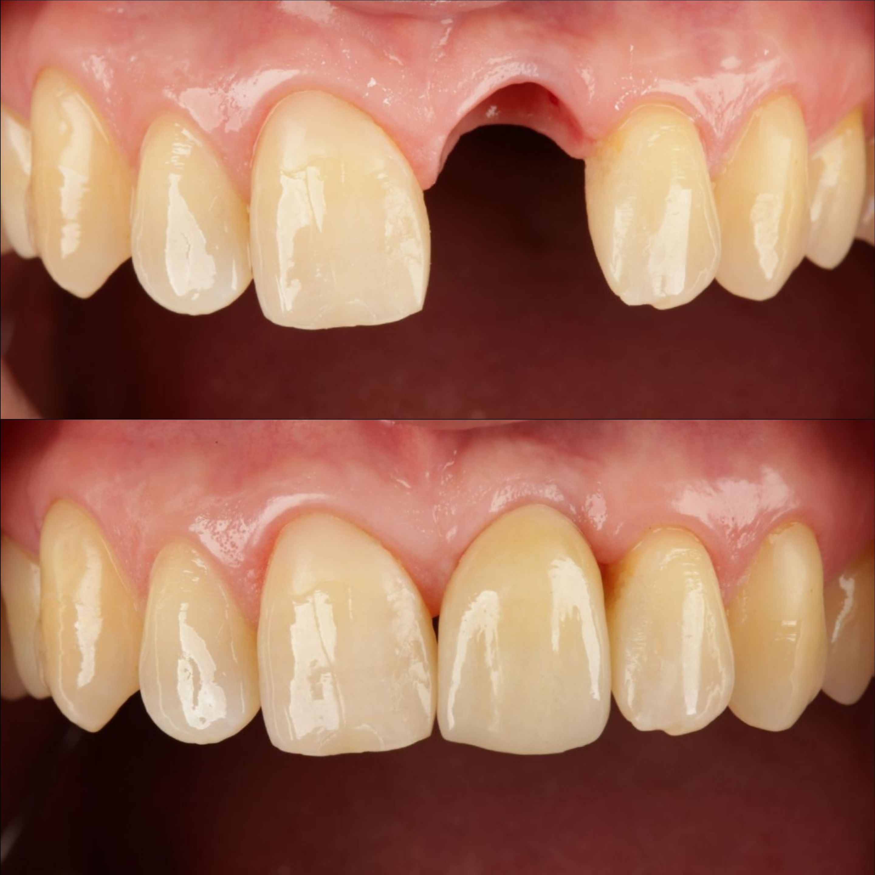 Восстановление отсутствующего зуба имплантом , индивидуальным имплантом и циркониевой  коронкой на нем